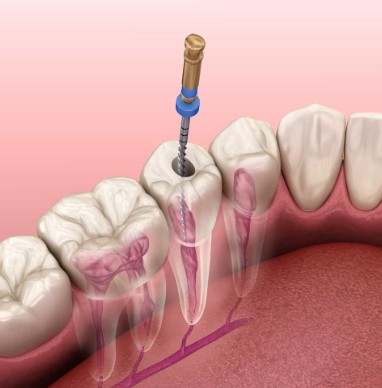 Root Canal Treatment